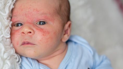 Puntini Rossi Neonato Dermatite Acne Neonatale Sesta Malattia