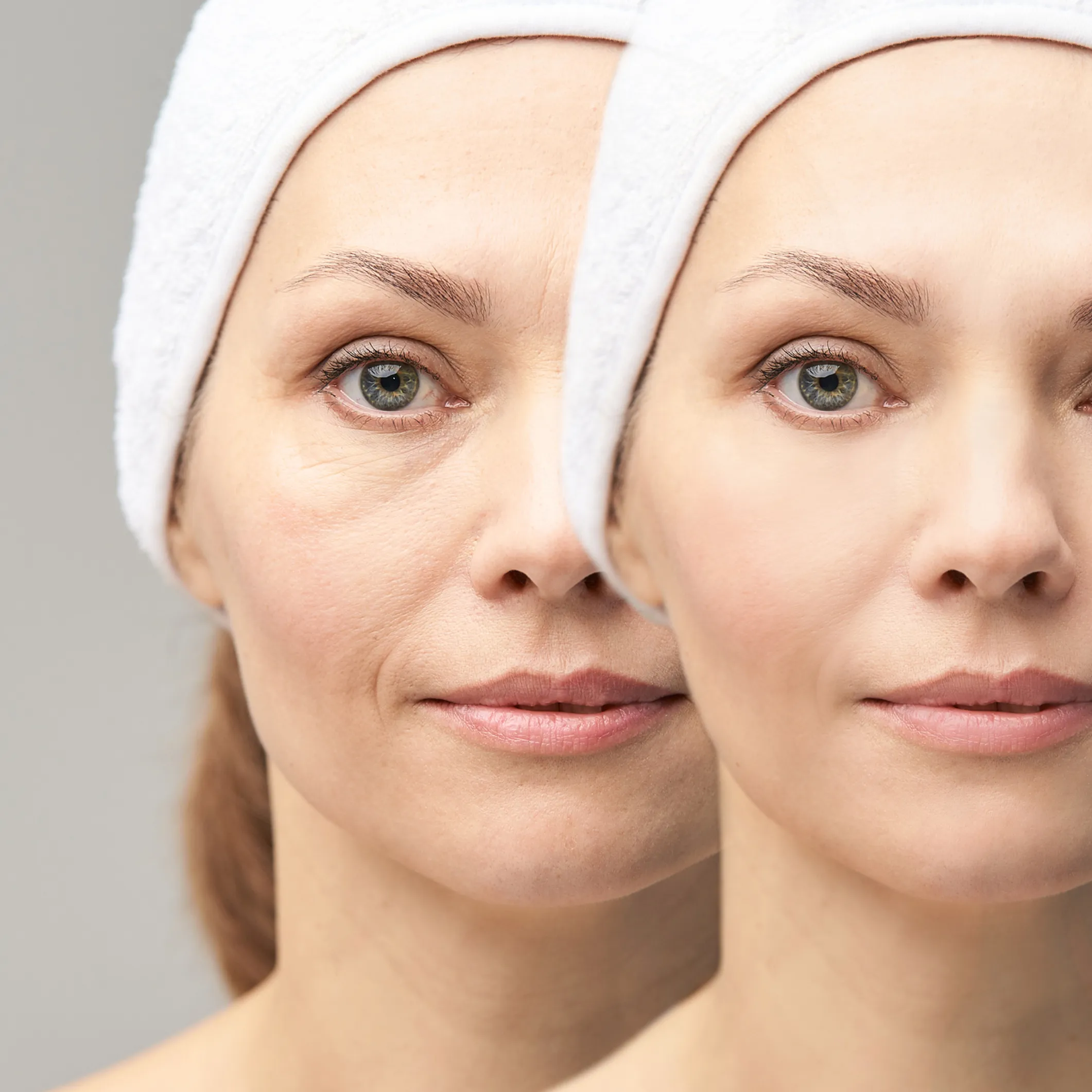 Rughe Sotto Gli Occhi Ecco Come Eliminarle O Ridurle