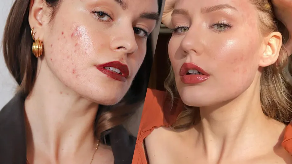 3 comptes Instagram à suivre pour se décomplexer d’avoir de l’acné