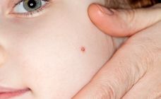 Puntini Rossi Neonato Dermatite Acne Neonatale Sesta Malattia