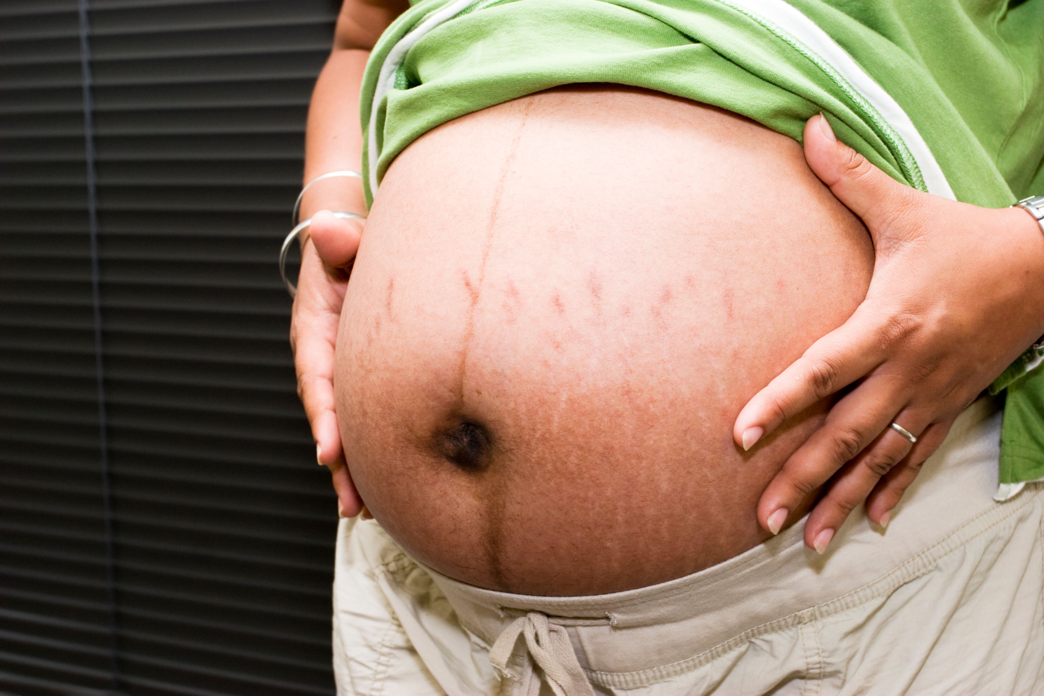 Забеременела после. Растяжки на животе при беременности. Беременные животы с растяжками.