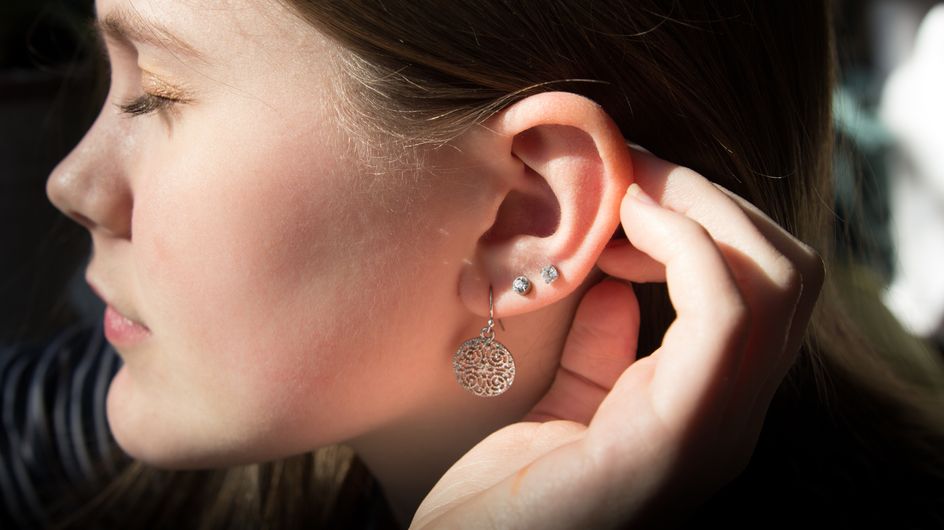 Chéloïde due à un piercing qu