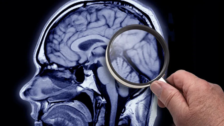 Alzheimer : nouvelle découverte pour ralentir l’évolution de la maladie