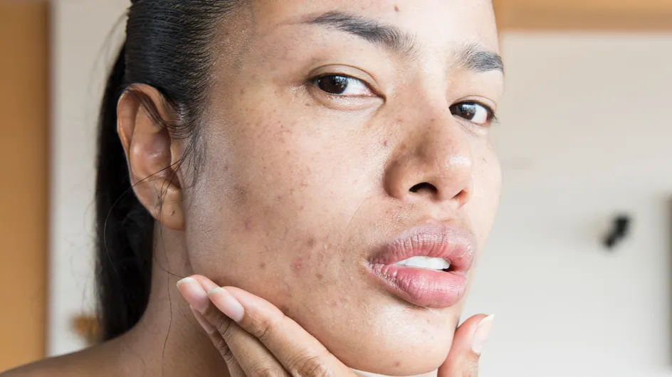 Acné : une micro-algue miracle pour guérir l’acné ?