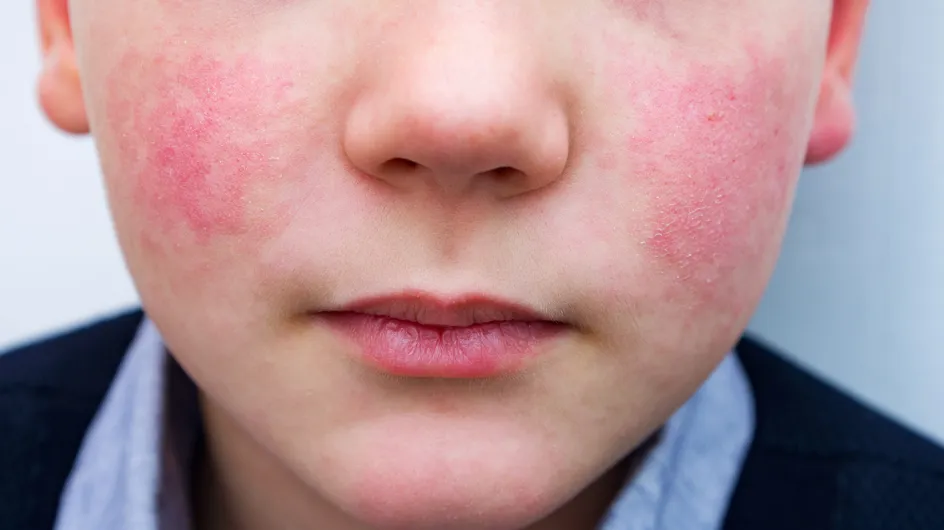 Guance rosse nei bambini: e se fosse quinta malattia? Scorpi i sintomi e i rimedi di quest'infezione