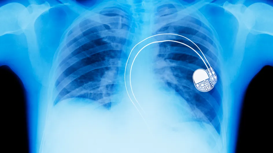 Santé : plus de 16 300 Français auraient un pacemaker défectueux