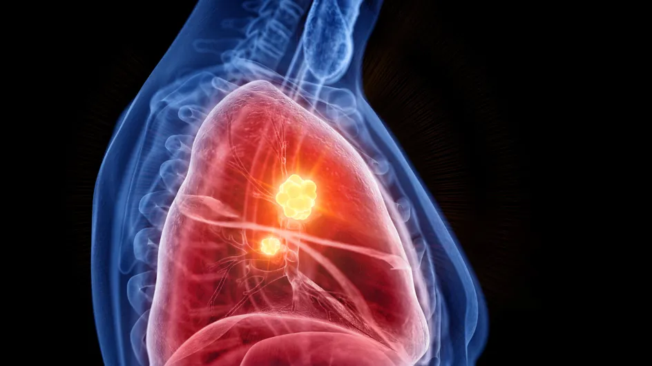 Cancer du poumon : cette nouvelle méthode pourrait aider à le détecter