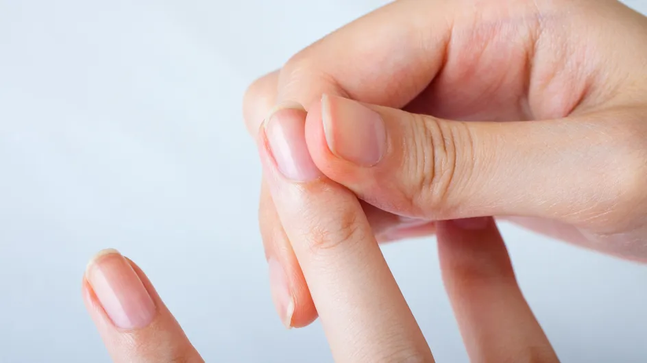 Gelbe Fingernägel: Mit diesen Blitz-Tipps bekommst du sie wieder weiß