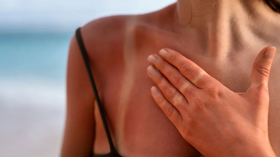Coup de soleil : ce produit naturel est le plus efficace pour apaiser la peau, selon les dermatologues