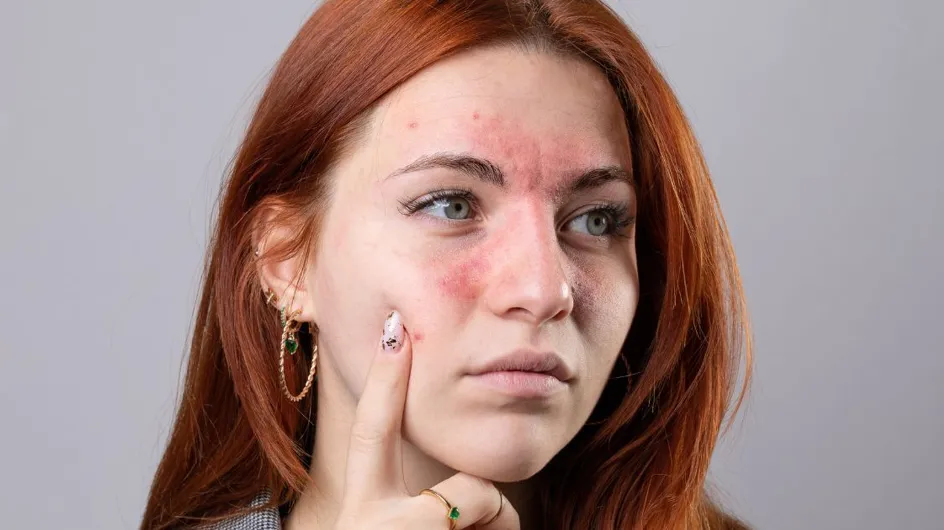 Covid 19 : ce nouveau symptôme visible sur le visage du variant Pirola