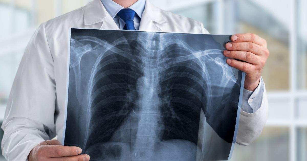 Cancer du poumon : ces 4 signes sournois auxquels faire attention, selon un chirurgien