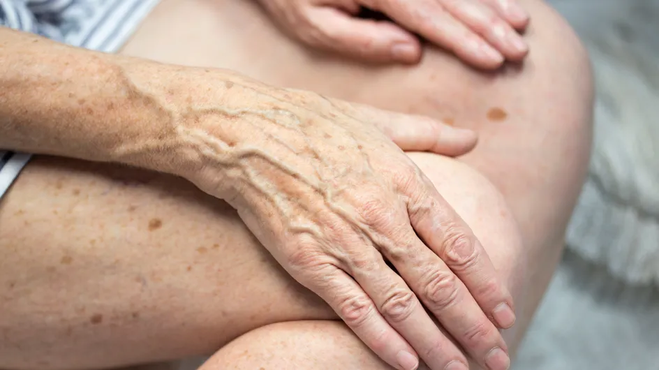 Cómo evitar las manchas de las manos a partir de los 60 años