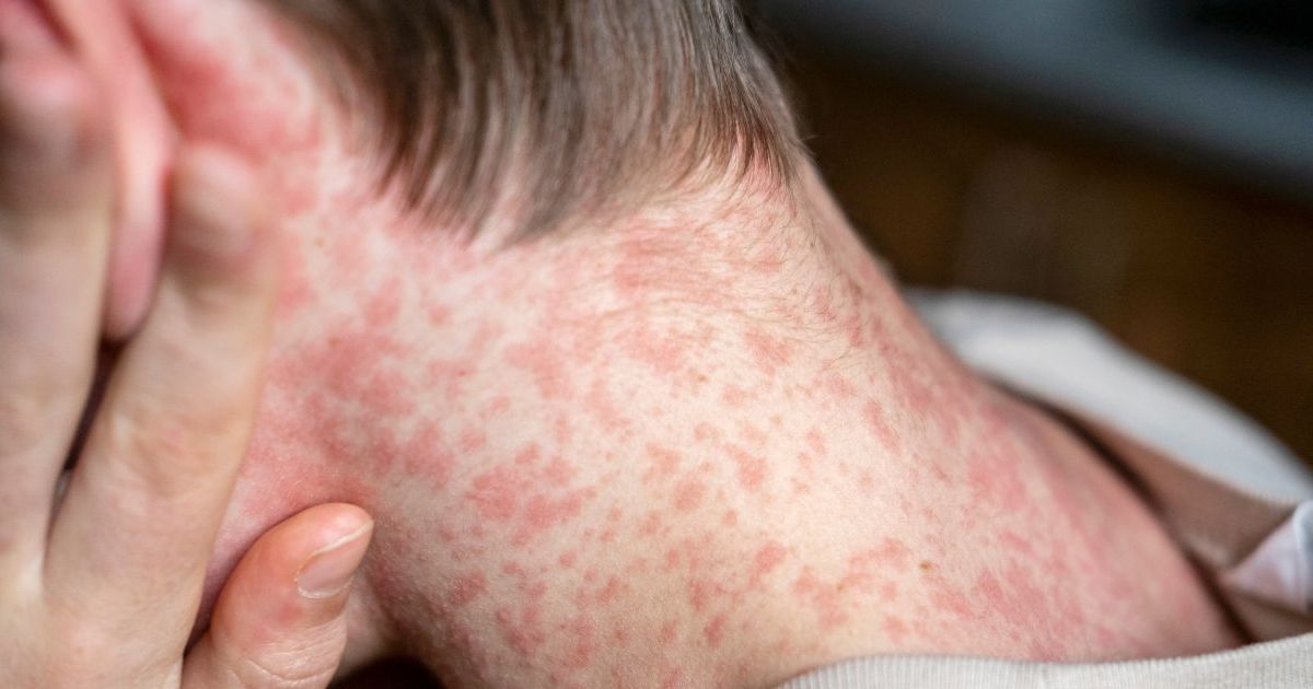 La rougeole explose en France et elle est très contagieuse : voici les ...