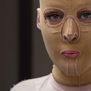 La increíble historia de Dana, la joven que descubre su rostro dos años después de que se lo quemasen