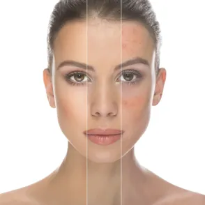 #YouLookDisgusting, belleza más allá del acné