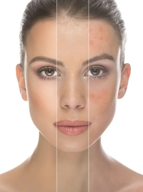 #YouLookDisgusting, belleza más allá del acné