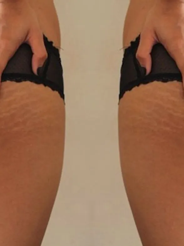Women Are Celebrating Their Imperfections With #ThighReading