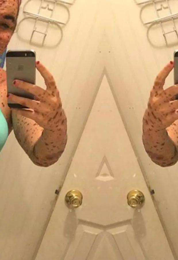 'I'm Proud To Be Different' This Teen Shut Down Bullies By Learning To Embrace Her Birthmarks