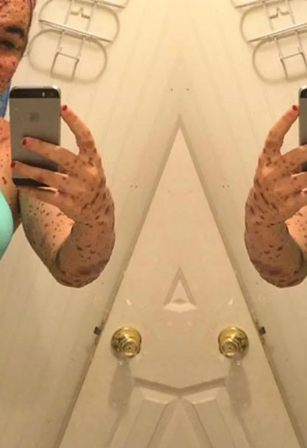 'I'm Proud To Be Different' This Teen Shut Down Bullies By Learning To Embrace Her Birthmarks