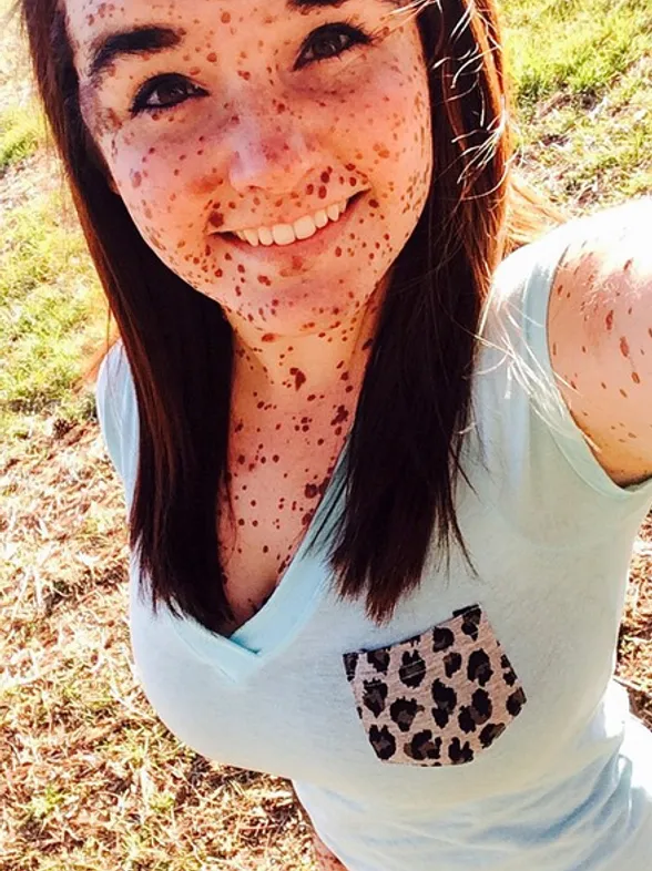 Una joven sufrió bullying por sus marcas de nacimiento hasta que decidió mostrarlas orgullosa