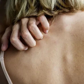 Urticaria: qué es y cómo aliviar el picor