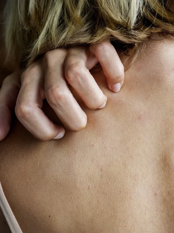 Urticaria: qué es y cómo aliviar el picor