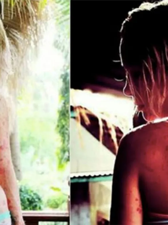 Psoriasis Sufferer Finally Feels Beautiful In Her Own Skin After Years Of Feeling Like A 'Freak'