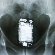 Los 24 objetos más raros encontrados, dentro de una persona, al hacer una radiografía