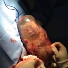 [Vídeo] Un bebé nace con la bolsa amniótica sin romper y se mueve como si estuviera en la tripa de su madre