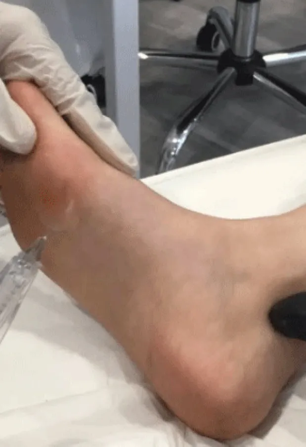 Could Feet Fillers Spell The End Of High Heel Pain?