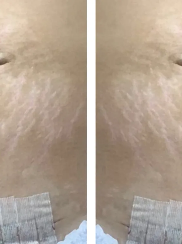 This Woman Is Setting The Record Straight For Pregnant Women Everywhere, One C-Section Photo At A Time