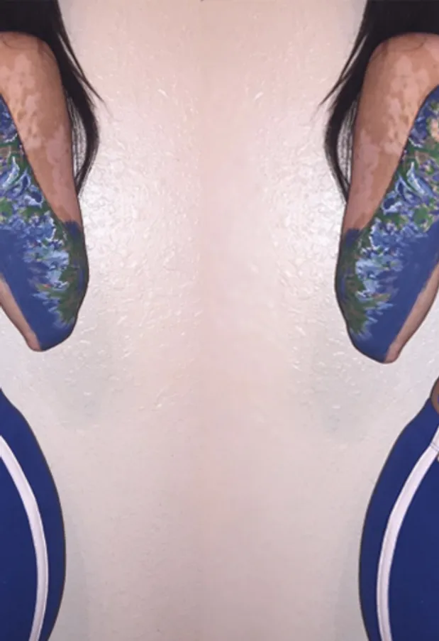 This Woman With Vitiligo Claps Back At Bullies By Turning Her Skin Into A Work Of Art