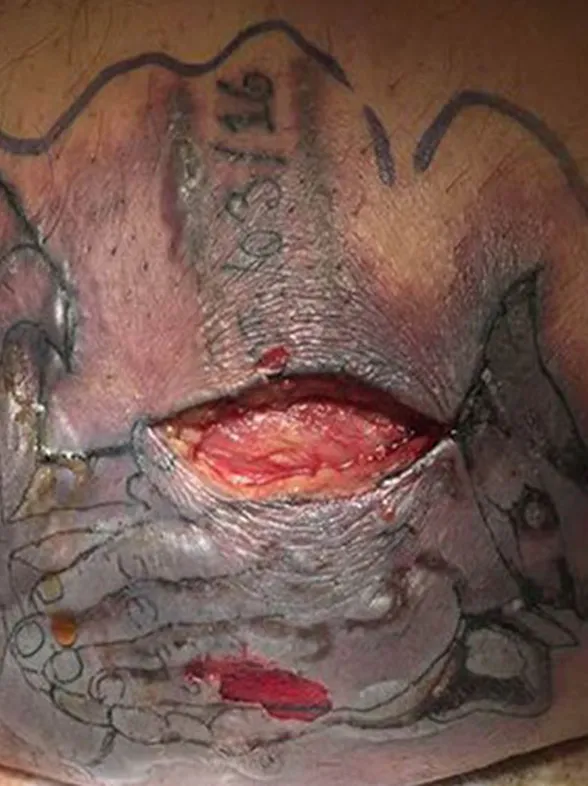 A Man Died From A Flesh-eating Bacteria After He Went Swimming With His New Tattoo