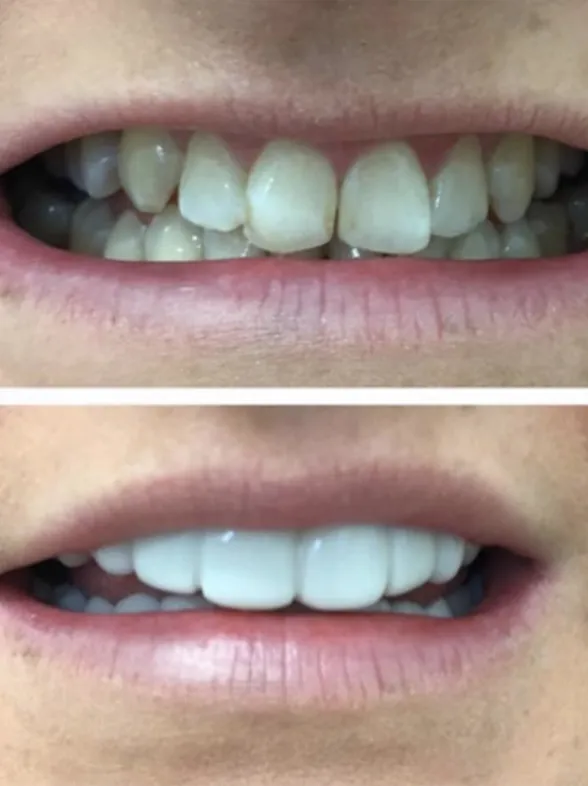 Clip On Teeth Veneers Are Here To Make You Look Like A Real Life Ross Geller