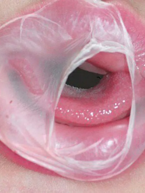Unprotected Oral Sex Is Leading To A Rise In Untreatable STDs
