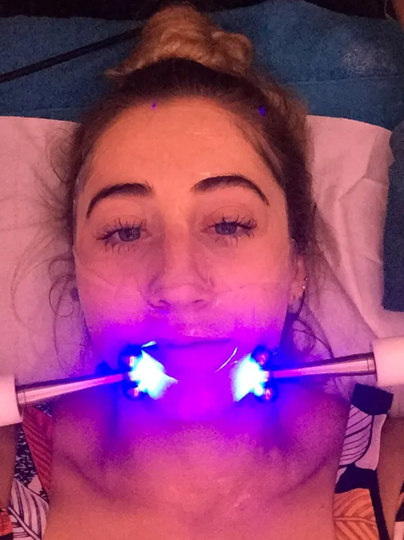 I Tried CACI Synergy Purifying Treatment To Banish My Acne Scarring & This Is What I Thought