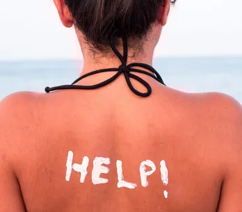 Foi à praia e ficou igual a um ~camarão~ ? Calma que a gente te ajuda!