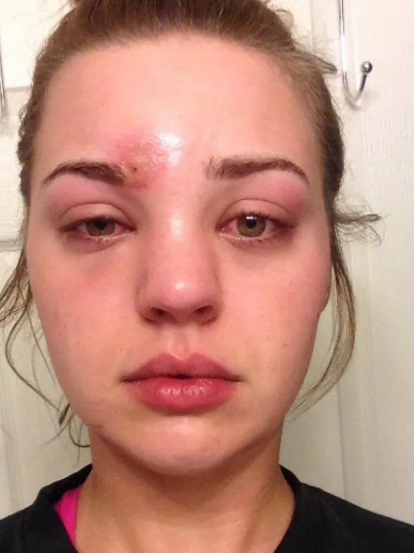 You'll Never Use A Spoolie Brush Again After Seeing What Happened When This Woman Squeezed A Spot