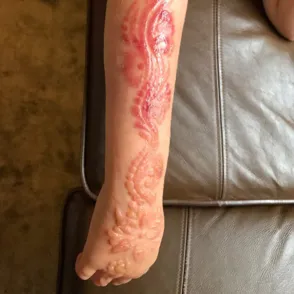 This 7-year-old Girl Suffered Horrific Burns After Getting A Holiday Henna Tattoo