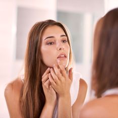 7 falsos mitos sobre el acné que deberías saber