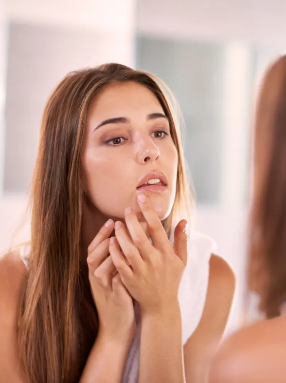 7 falsos mitos sobre el acné que deberías saber