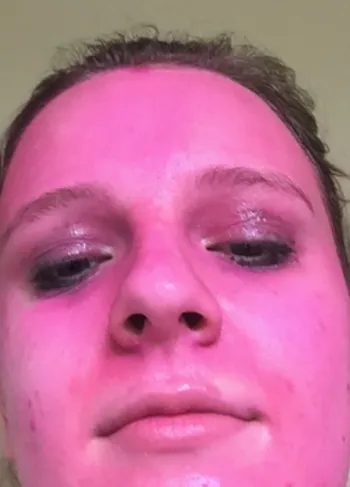 Woman's Face Stained Pink After Applying 'Washable' Glitter Paint