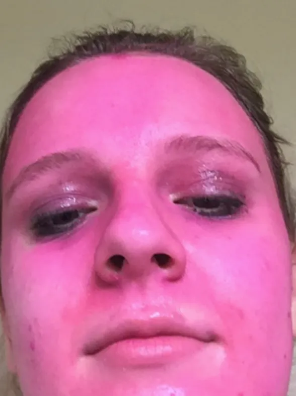Woman's Face Stained Pink After Applying 'Washable' Glitter Paint
