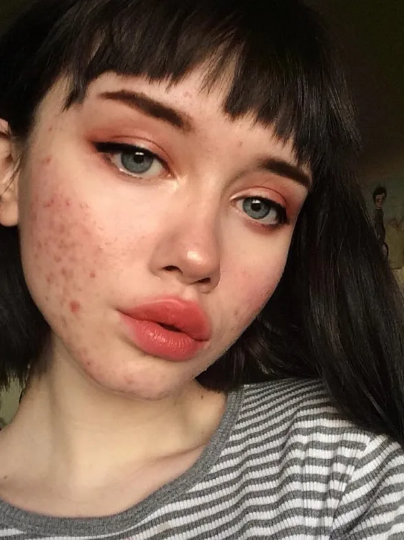 Esta instagramer muestra su acné para luchar contra los estereotipos de belleza