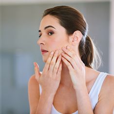 Rimedi naturali contro l'acne: ecco i più efficaci