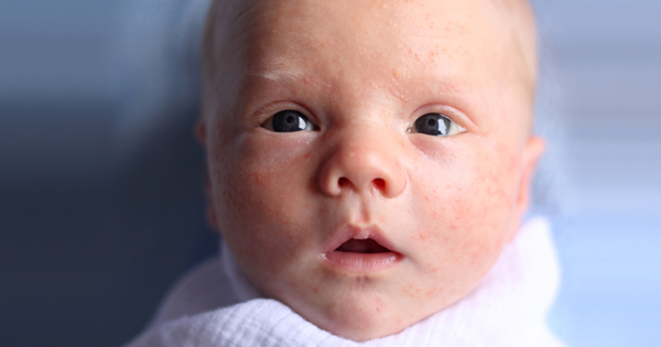 Babyakne Ursachen Tipps Zu Den Storenden Pickelchen