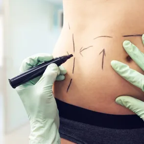 Liposucción láser: todo lo que debes saber sobre esta técnica
