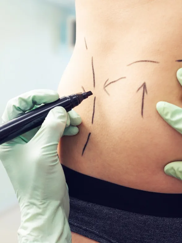 Liposucción láser: todo lo que debes saber sobre esta técnica