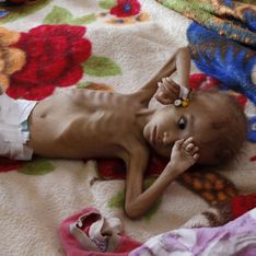 85 000 enfants de moins de 5 ans seraient morts de faim depuis le début de la guerre au Yémen