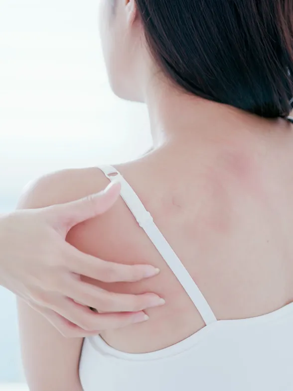 ¿Tienes picor, enrojecimiento o ronchas en la piel? Podría no ser alergia